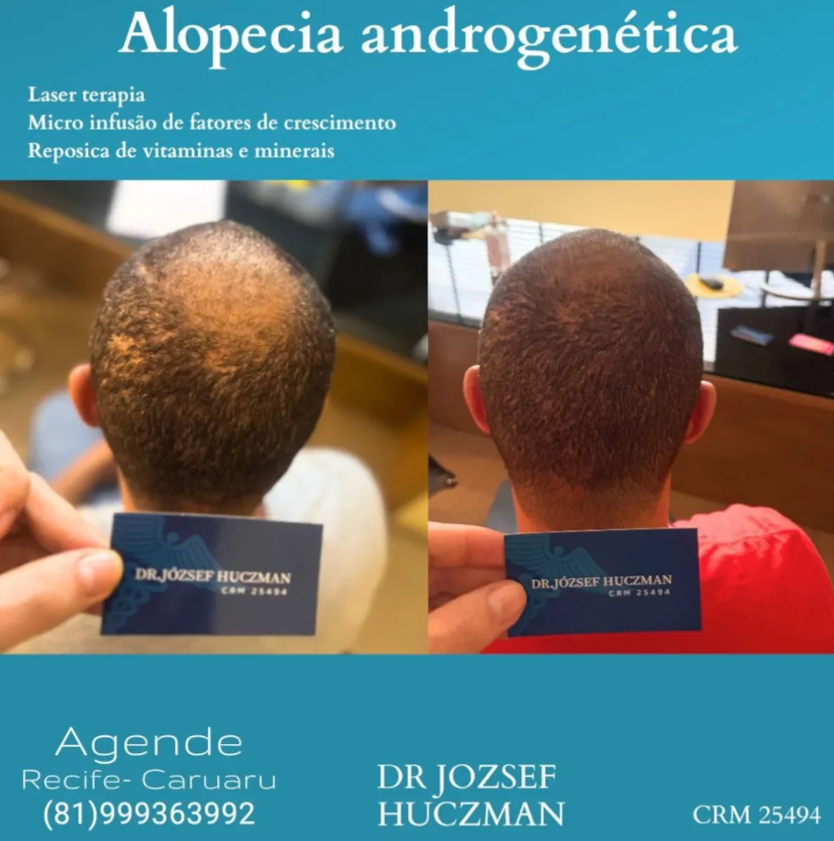 Tratamento para Alopecia Androgenética