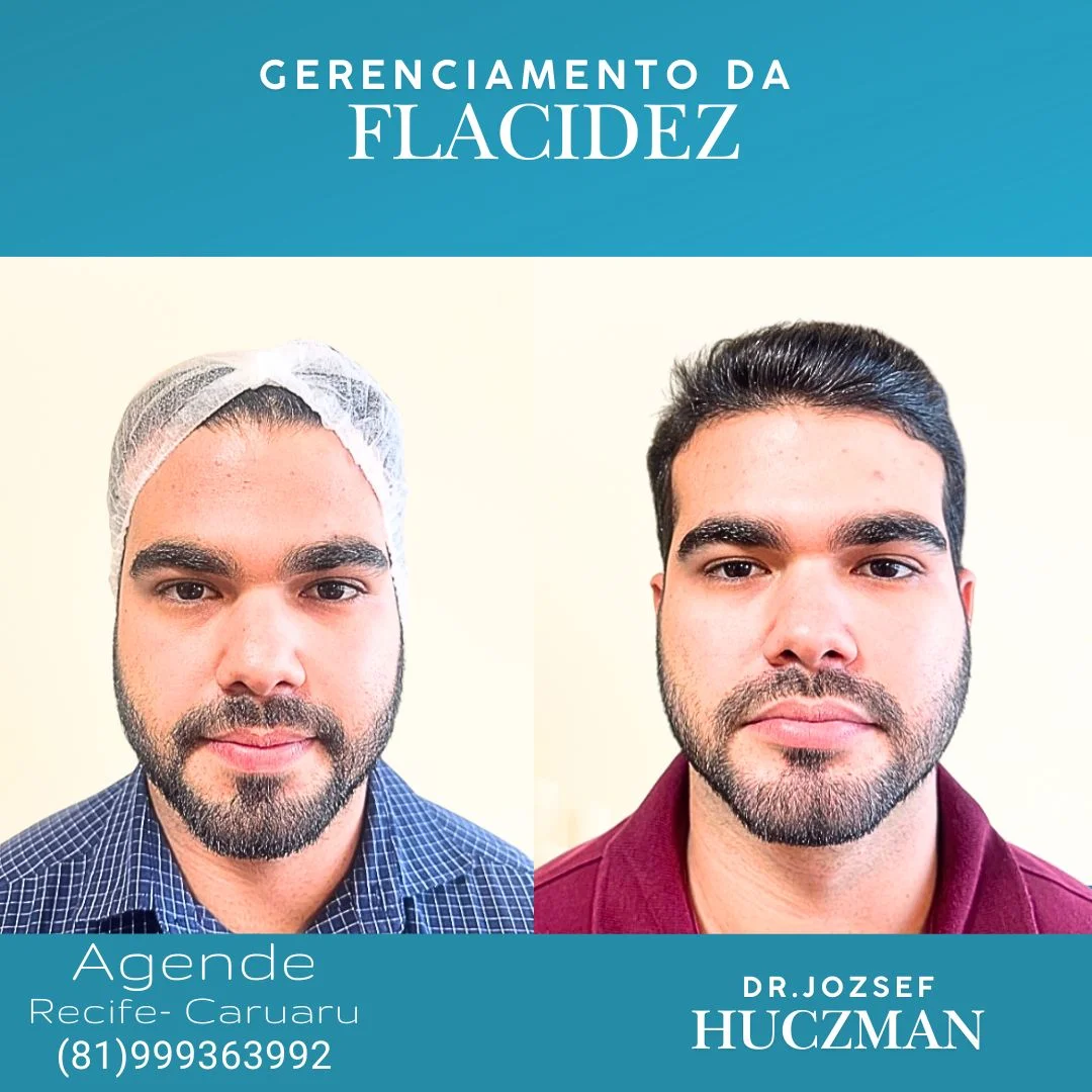 Resultados de Harmonização Facial